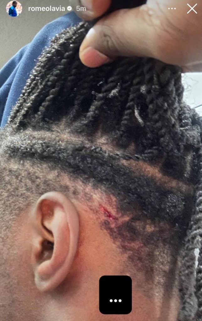 A cut on Romeo Lavia's head.